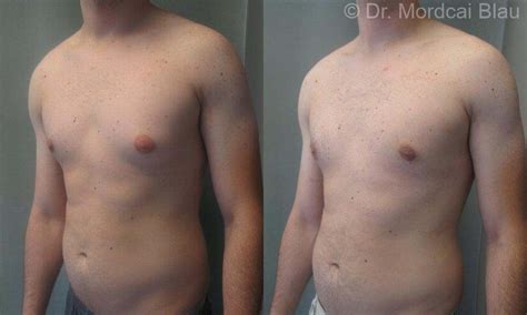 Gynecomastia Before and After Photos Case 29 .